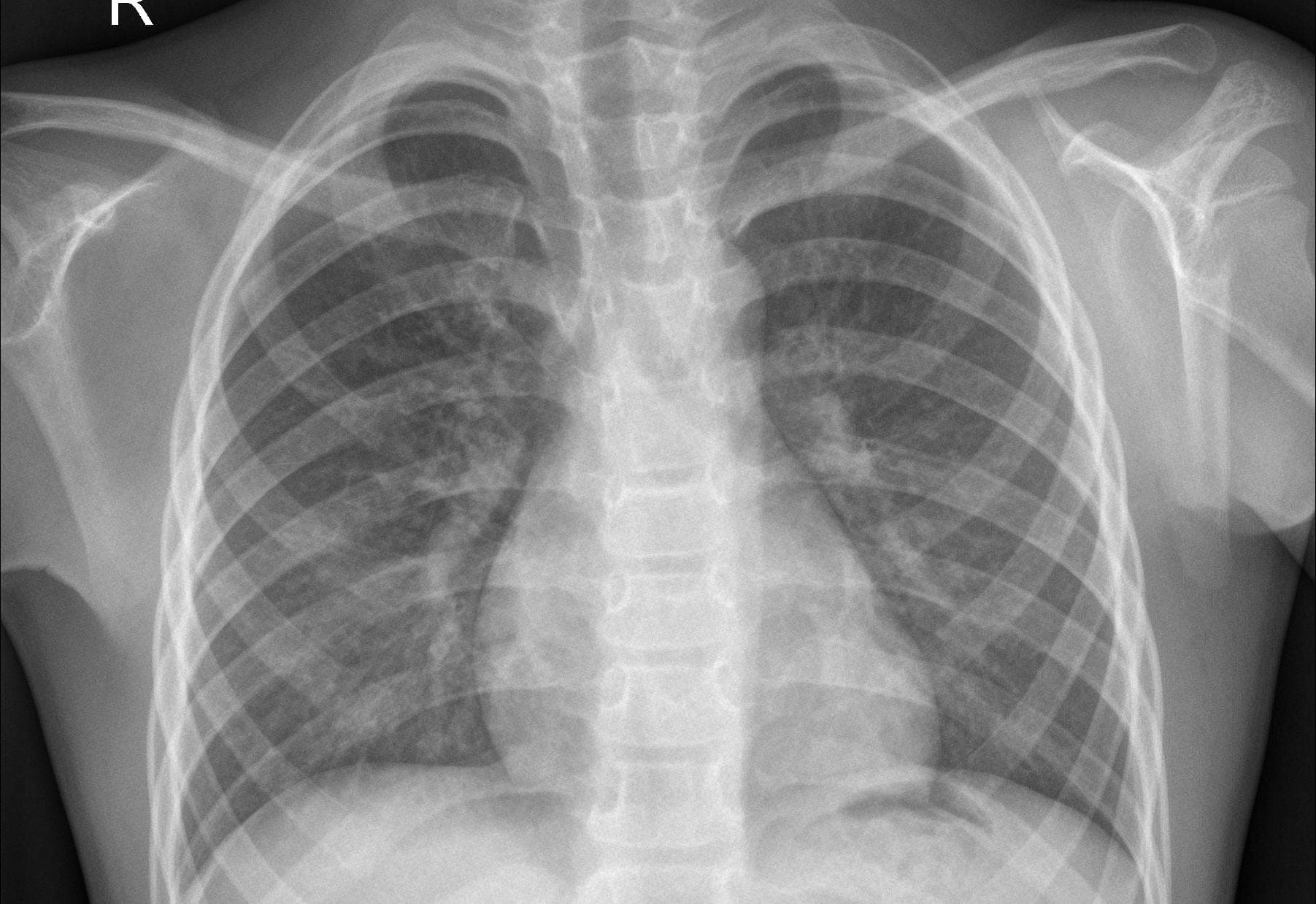 Lung Cancer Detection (CNN)